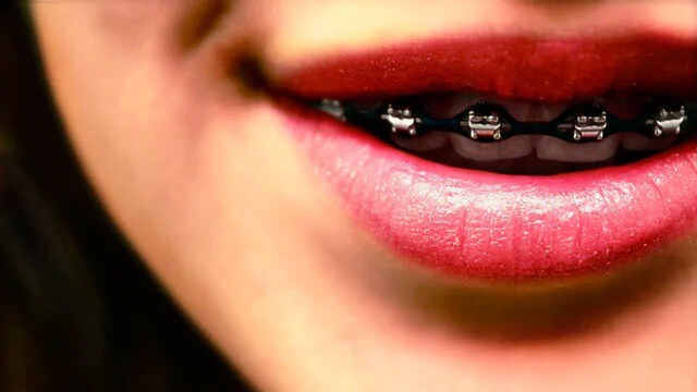 woman with clean braces smiling