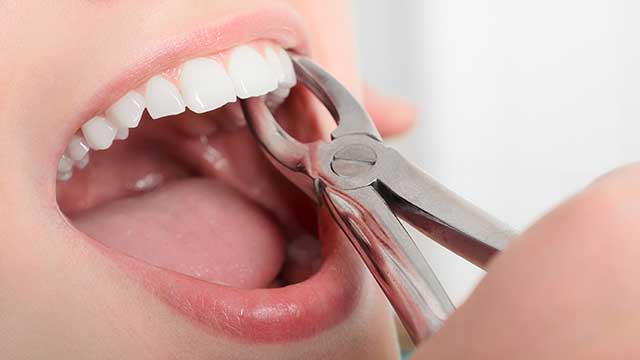 what you need to know anout tooth extractions - colgate ph