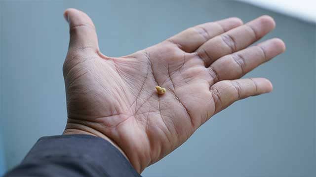 tonsil-stones-on-palm