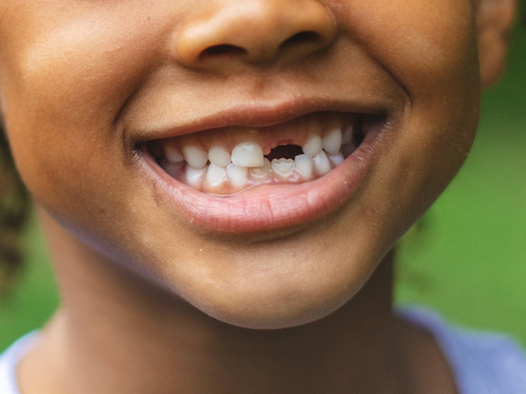 child showing missing front tooth