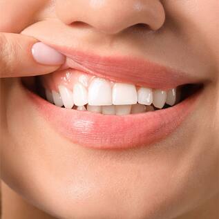 Prevent Cavities Prevent Cavities