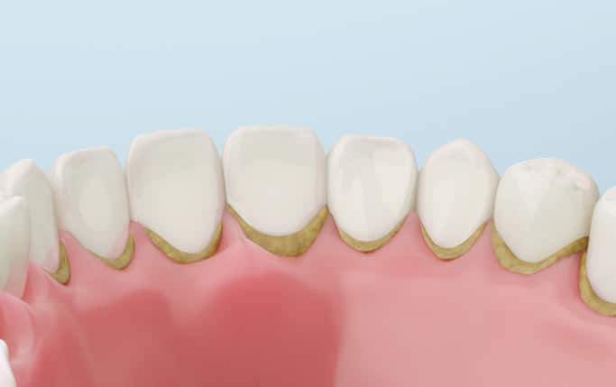 Dental tartar