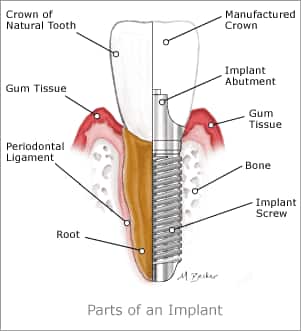parts of dental implant - colgate in