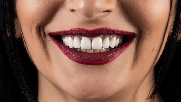woman smiling after Porcelain Veneers treatment