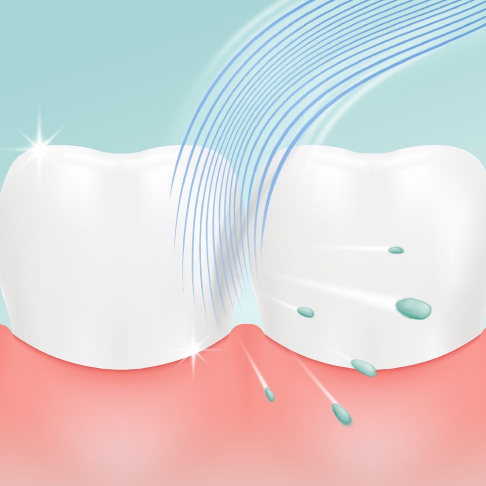 Particles in between teeth removed