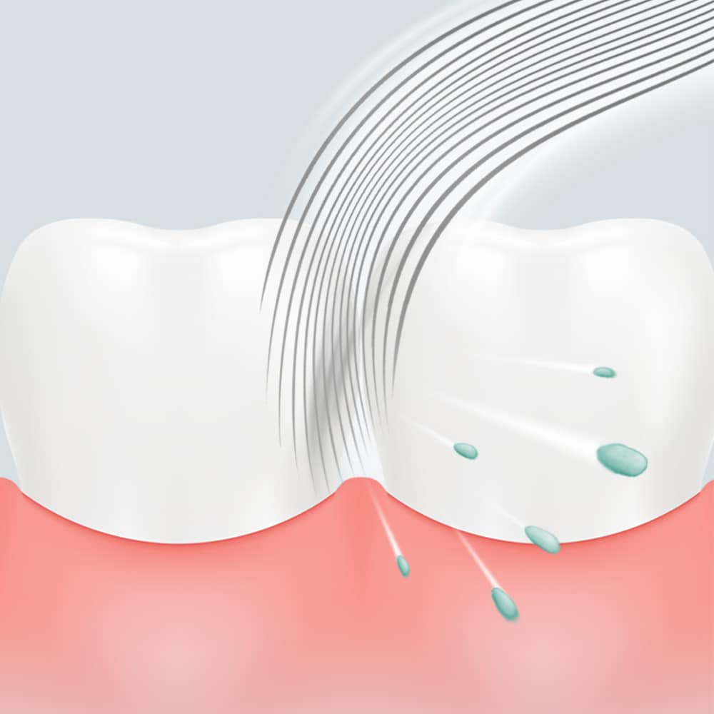 Particles in between teeth removed
