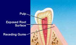 RecedingGums