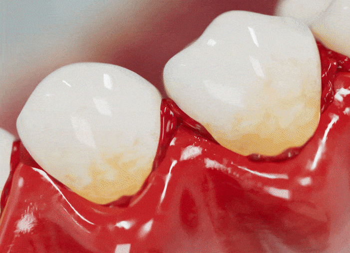 PerioGardSF long-lasting gum protection