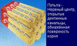 пульпа зуба-фото