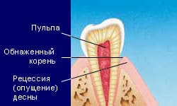 чувствительные зубы-фото