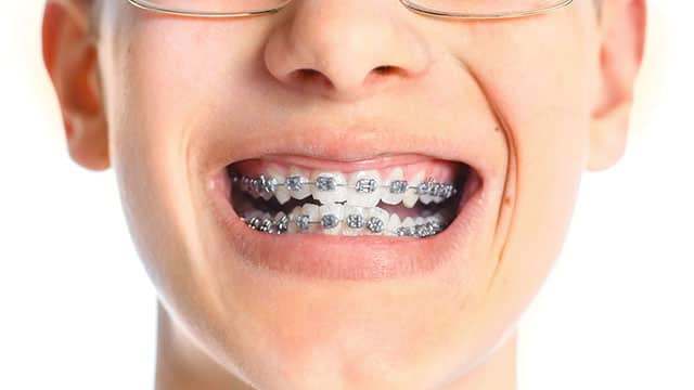 Los arcos dentales y su utilidad en ortodoncia con brackets