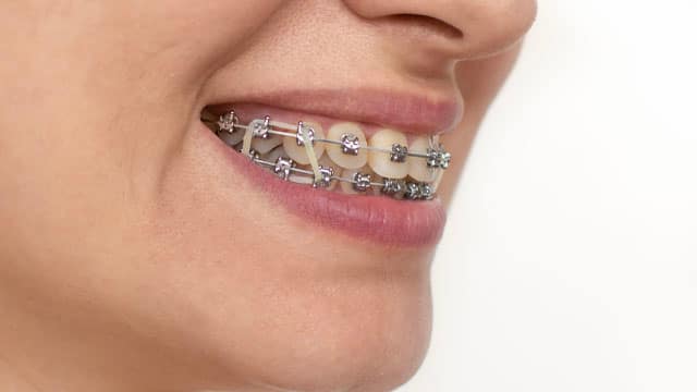 Close up of smiling woman with rubber bands on her braces.
