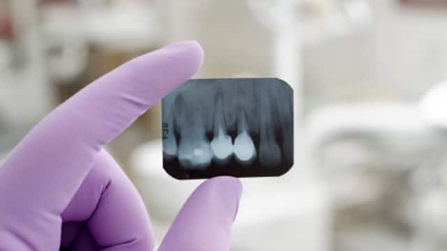 Dentist hands holding one tiny x-ray image.