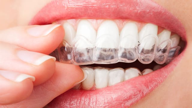 Whitening tray, white teeth - putting in tray