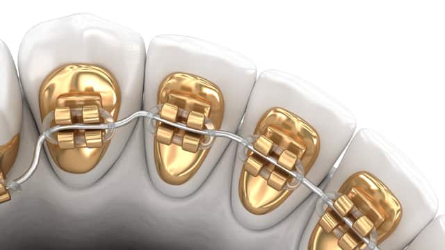 3D illustration concept of golden braces