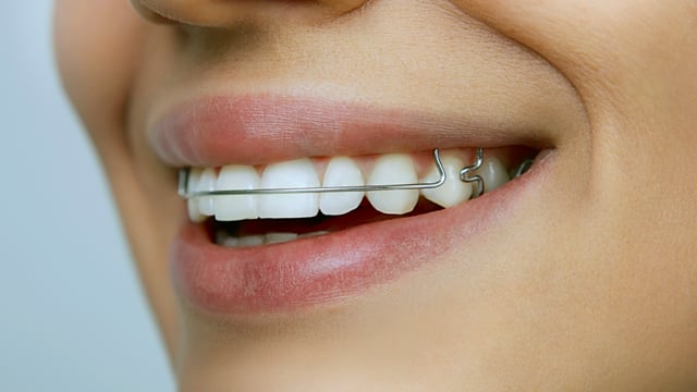 Closeup of woman smiling and wearing a retainer