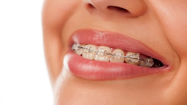 Girl Smiles with Braces