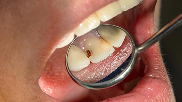 Revisión dental de caries