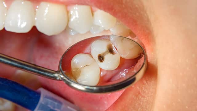 Caries as a Non-Communicable Disease
