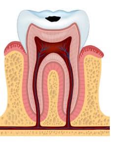 tooth decay stages - enamel decay - colgate my