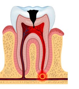 pulp involvement - cavity stages - colgate my