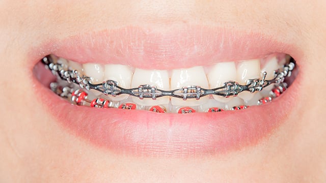 Dientes con brackets de cadena