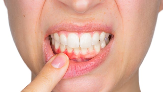 distancia Dedicación Sacrificio Inflamación de encía alrededor de un diente? | Colgate®