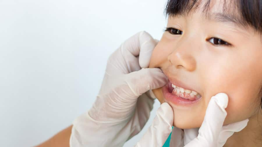what causes white spots on baby teeth - colgate ph