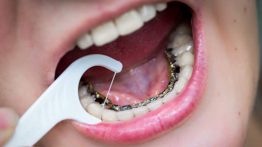 What are Lingual Braces and How They Work? | Colgate® PH