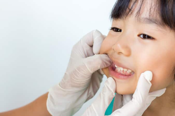 causes of cavity in kids and how to protect - colgate ph