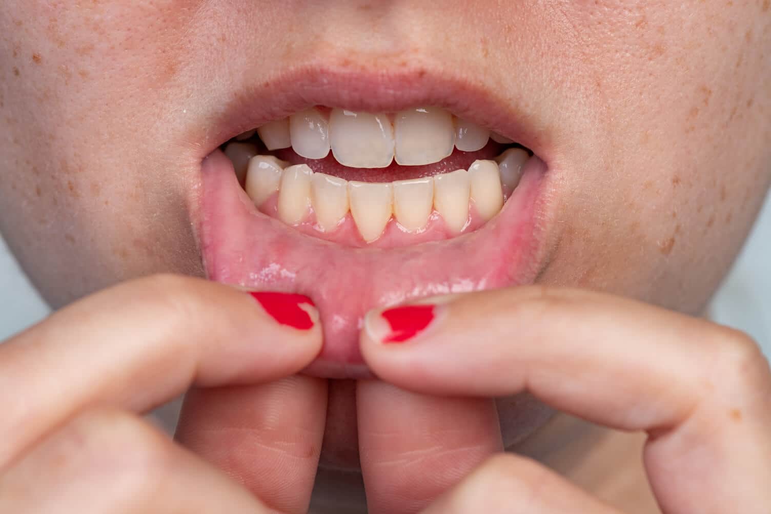 causes, treatment and prevention of gumline cavity - colgate ph