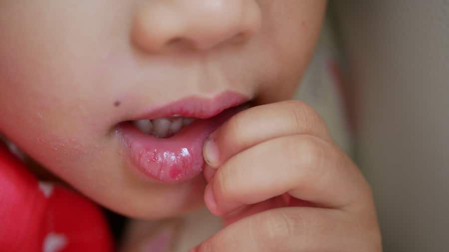 causes and treatments of baby mouth ulcers - colgate in