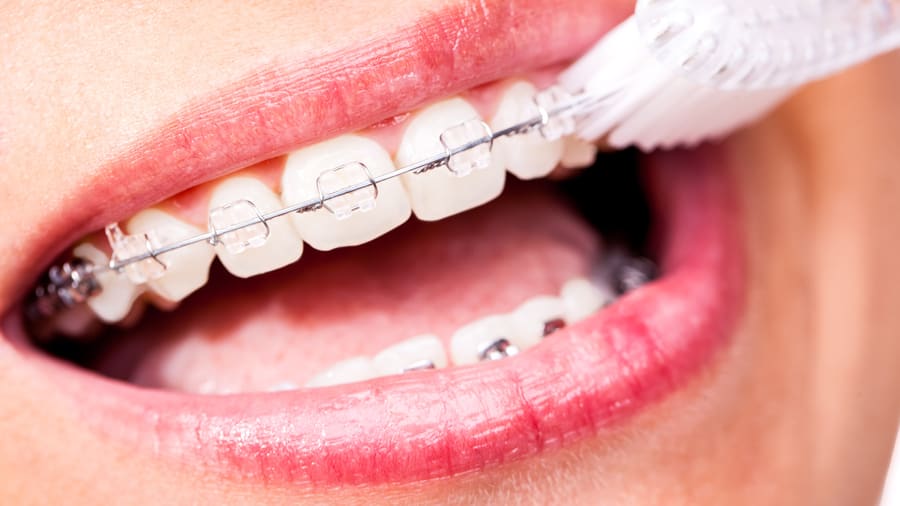 how to properly brush teeth with braces - colgate in