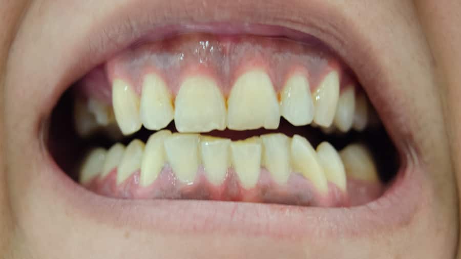 เหงือกดำ ฟันคล้ำ เกิดจากอะไร สาเหตุและวิธีแก้ไข | คอลเกต