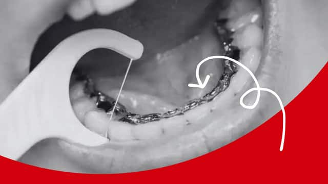 what are lingual braces and how they work - colgate ph