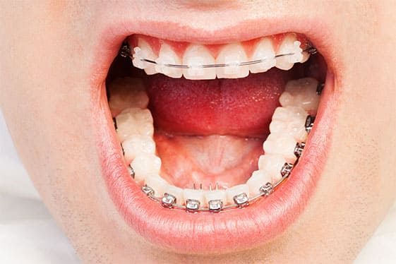 wide opened mouth selfligating brackets