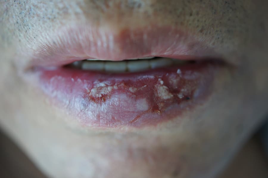 Queilitis y aftas en labios