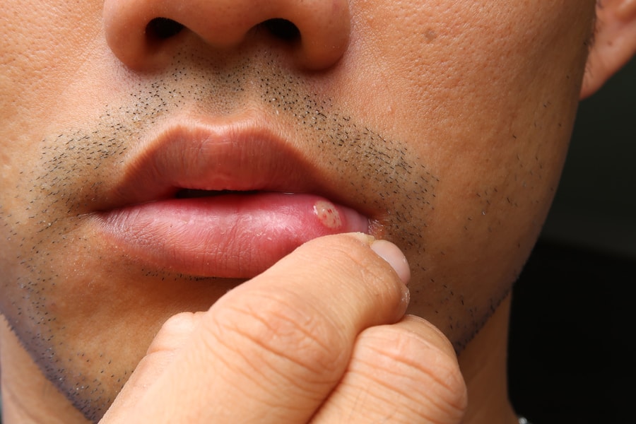 HERPES LABIAL CAUSAS | HERPES LABIAL TRATAMIENTO