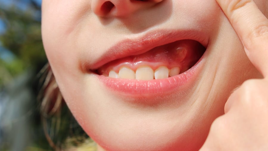 A girl suffering from gum boil