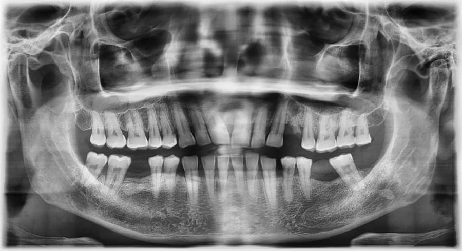 Radiografía dental