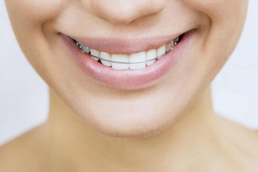 Joven con retenedores y sonrisa blanca