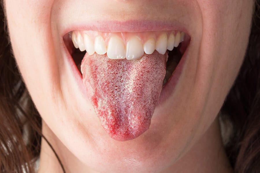 Lengua con hongo bucal por candidiasis