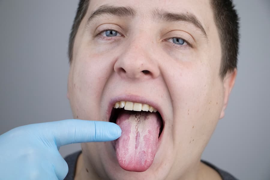 Um médico examina a língua de um homem com higiene oral deficient