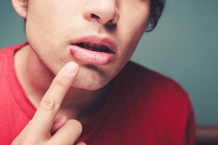 Hombre con herpes labial