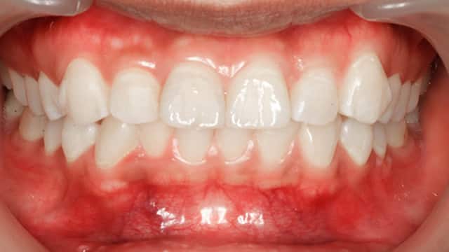Teeth before procedure 