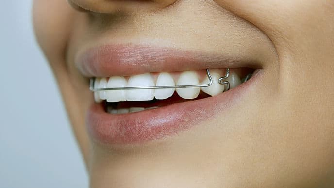 woman smiling showing retainers