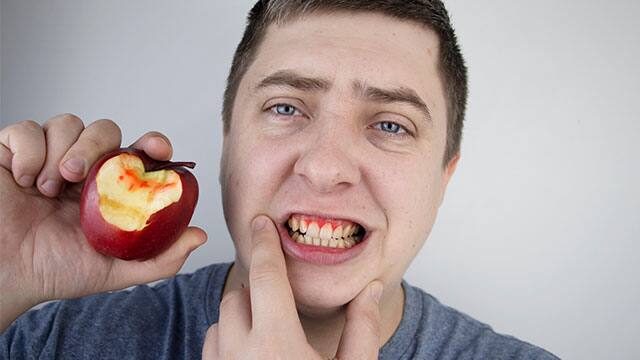 Inflamación gingival Inflamación gingival