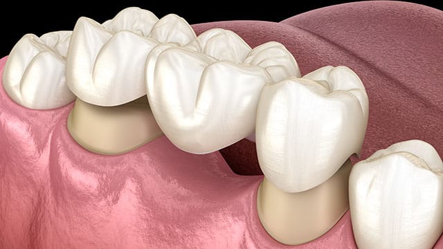 An image of the dental bridge