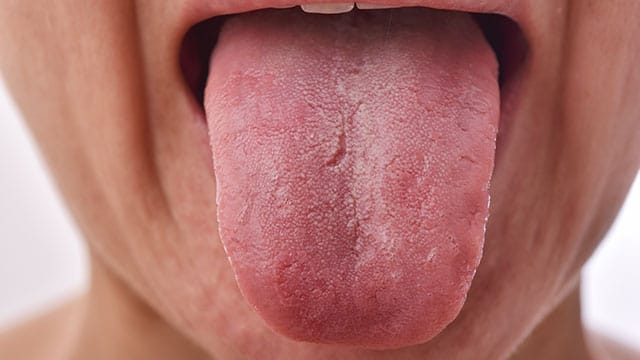 Lengua fisurada Lengua fisurada
