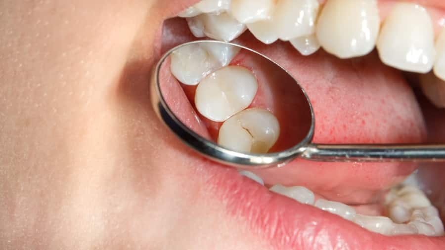 Caries: conozca un poco más sobre la enemiga de las sonrisas